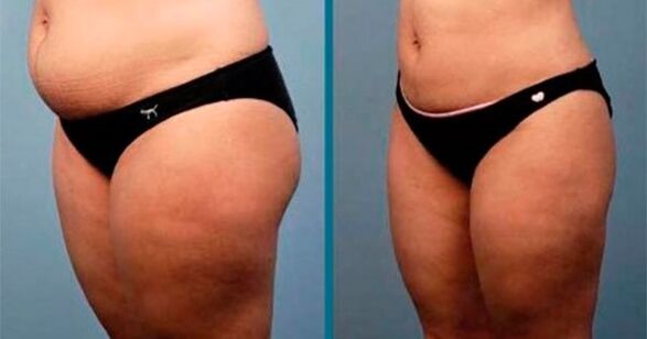 Metodat për të humbur peshë me 10 kilogramë në një muaj